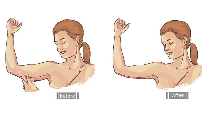 braquioplastia