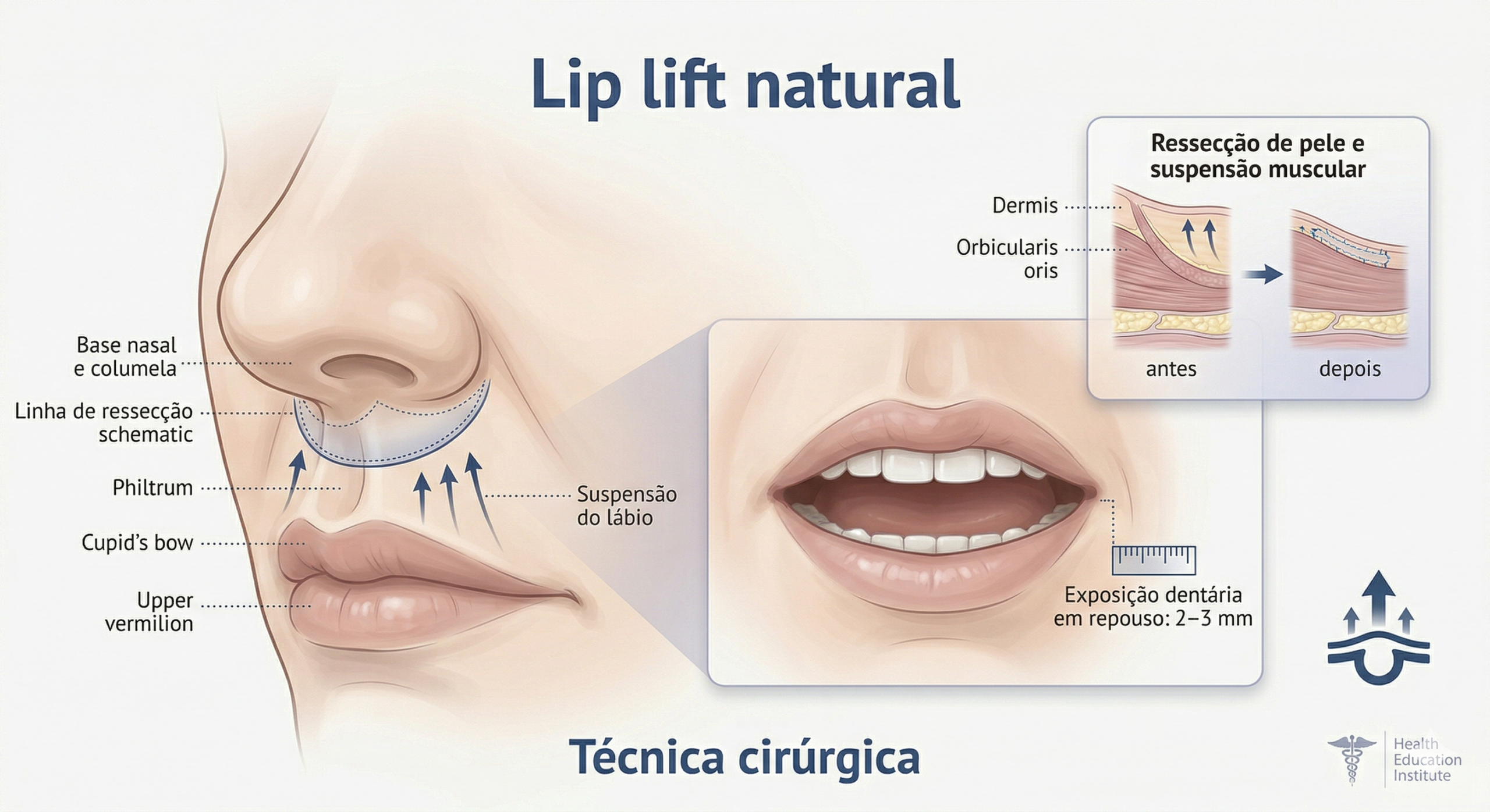 lip lift individualizado